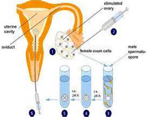转载：什么情况下做试管婴儿会发生宫外孕-生殖科普